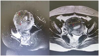 High-intensity focused ultrasound for endometrial ablation in adenomyosis: a clinical study